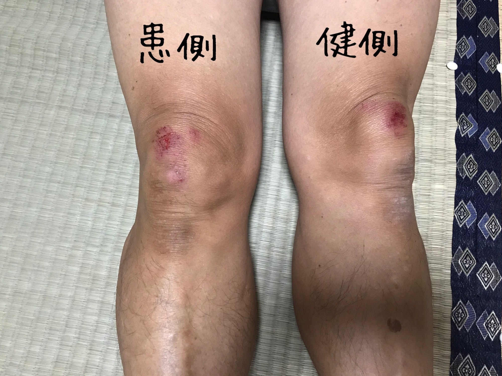 転倒で膝を強打 歩けていても骨折の可能性が A T Nagashima Wing 長崎 鍼灸整骨院 めがね橋へ